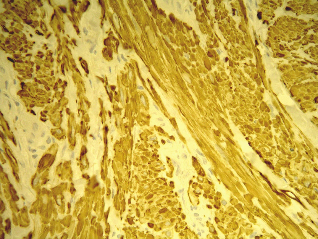 Tkáň je pozitivní v imunohistochemickém vyšetření na
desmin