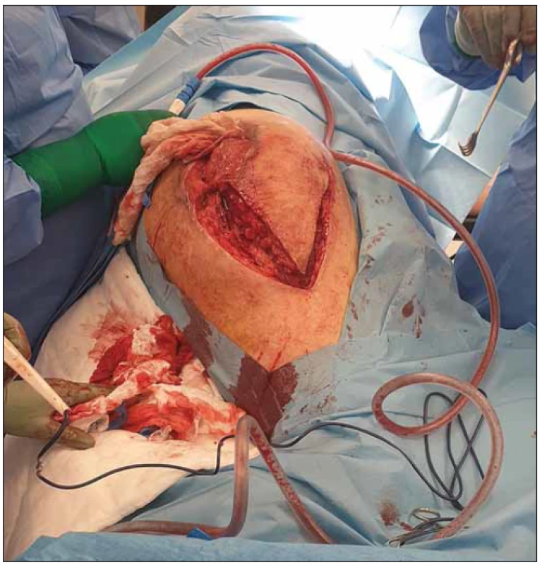Peroperation picture after elevation of large fasciocutaneous
flap for closure of trochanteric defect.<br>
Obr. 4. Peroperační snímek elevace fasciokutánního laloku k uzávěru
trochanterického dekubitu.