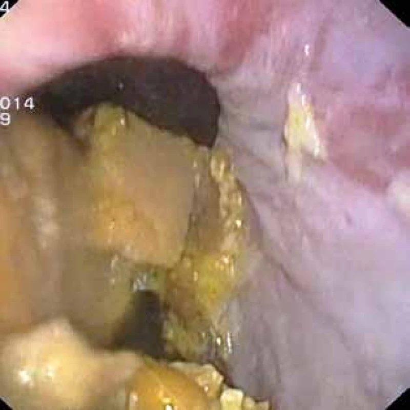 Divertikl středního jícnu s poruchou evakuace jícnu <br>Fig. 4: Middle oesophagal diverticulum with oesophageal evacuation disorder.