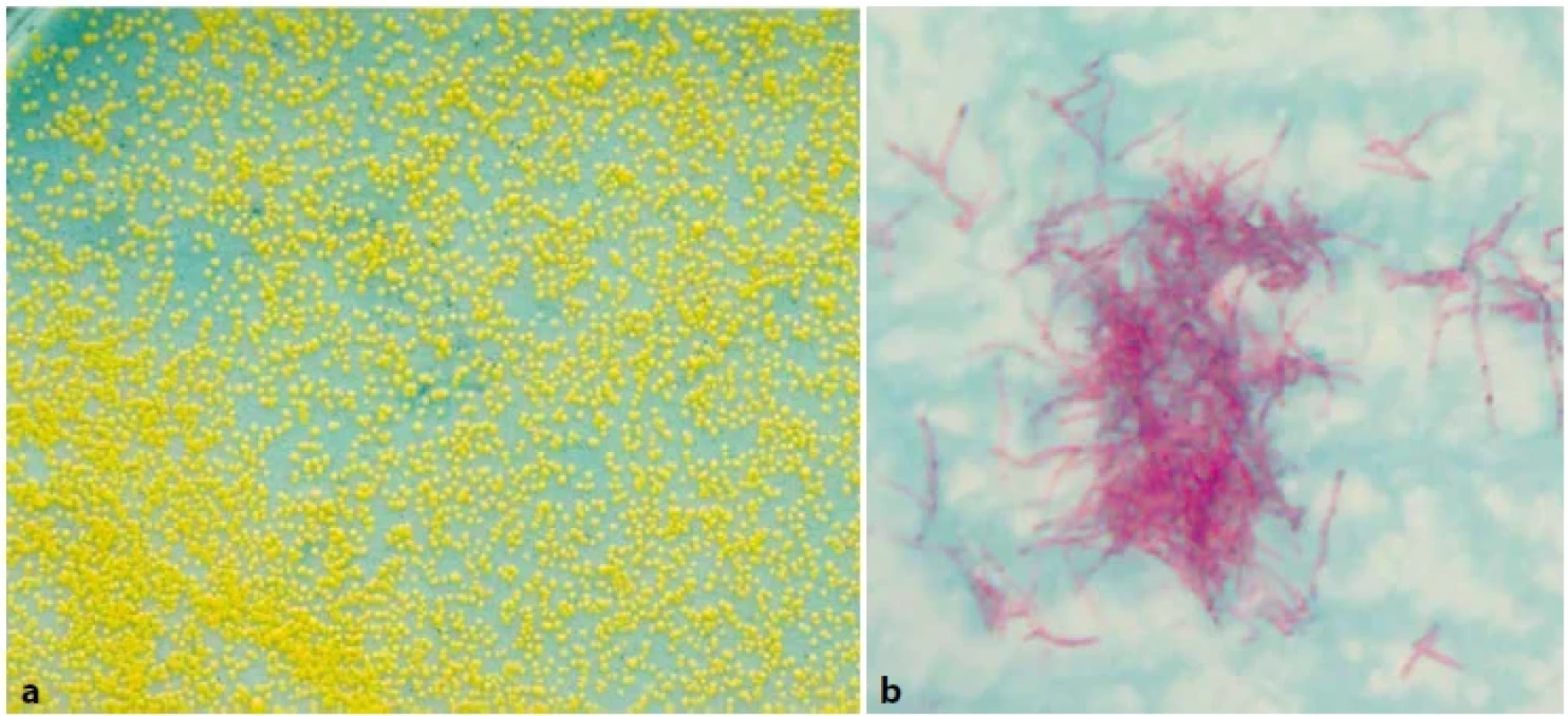 (a). M. xenopi na Löwenstein-Jensenově půdě, 14denní kultura.</br> Obr. 5 (b). M. xenopi, tvorba hnízdovitých útvarů (tzv. clustering) někdy označovaných jako ptačí hnízda, barvení dle Ziehl-Neelsena, zvětšeno 1 000x (foto V. Ulmann).</br>Figure 5 (a). M. xenopi on Löwenstein-Jensen medium, 14-day culture. </br>Figure 5 (b). M. xenopi, formation of nest-like formations (so-called clustering) sometimes referred to as bird’s nests, staining according to Ziehl-Neelsen, magnification 1,000x (Photo V. Ulmann).