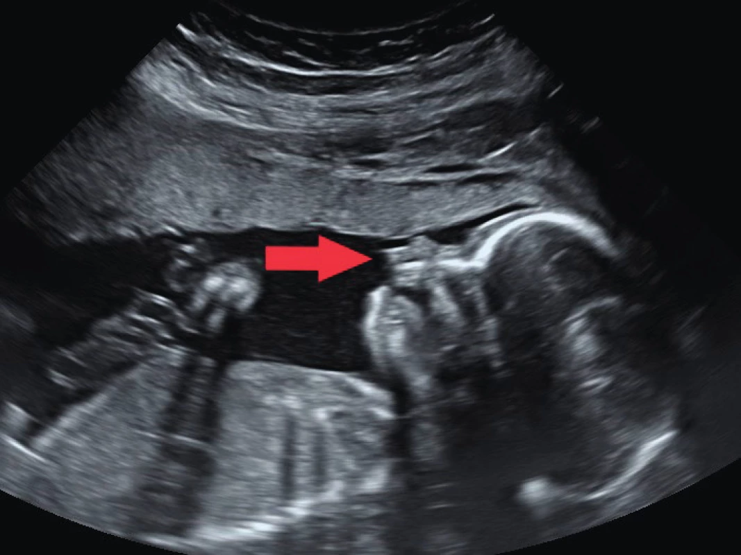 Sagitální řez ve 20. týdnu gravidity; protruze premaxily
označena šipkou