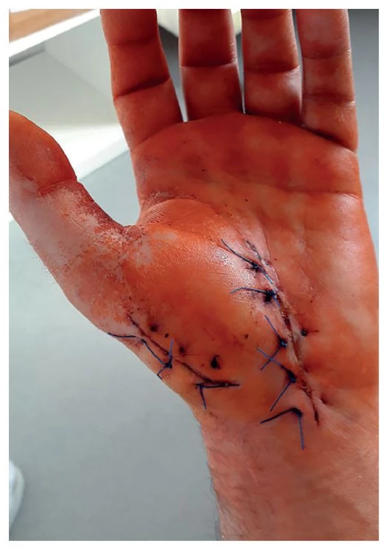 Levá ruka, 8. pooperační den<br>
Fig. 7: Left hand, postoperative day 8