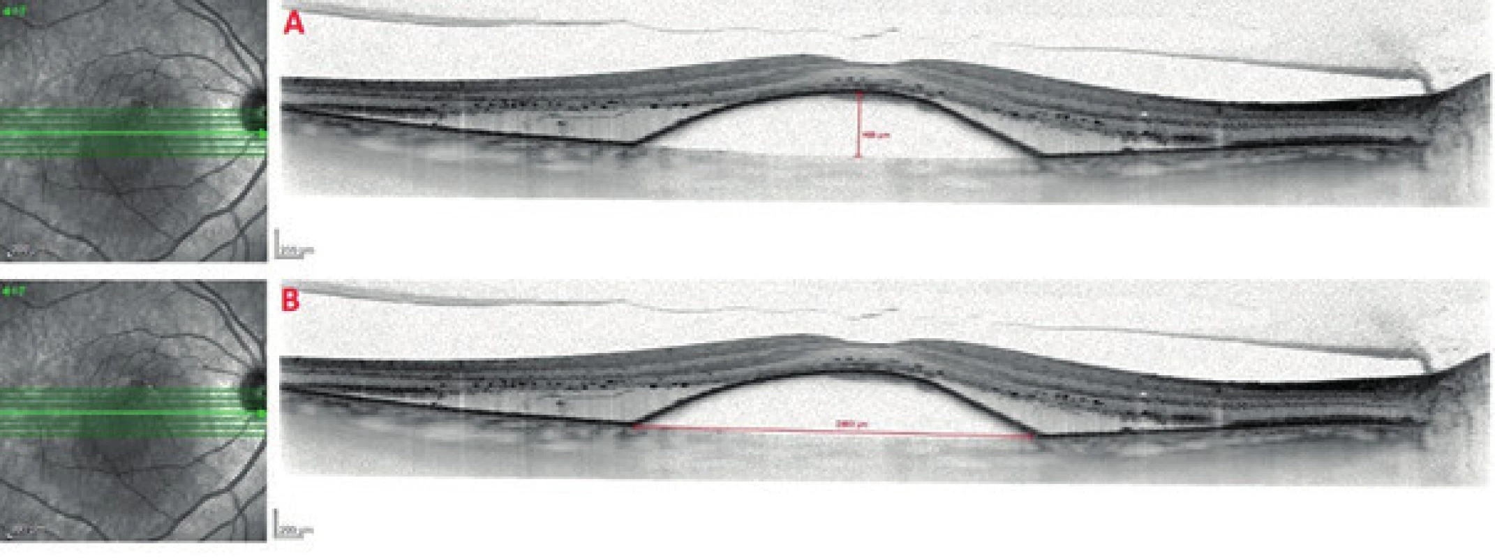 SD-OCT image of vascular serous detachment of retinal pigment epithelium upon a background of occult choroidal neovascularisation<br>
A. Method of measurement of height of RPE detachment<br>
B. Method of measurement of width of RPE detachment