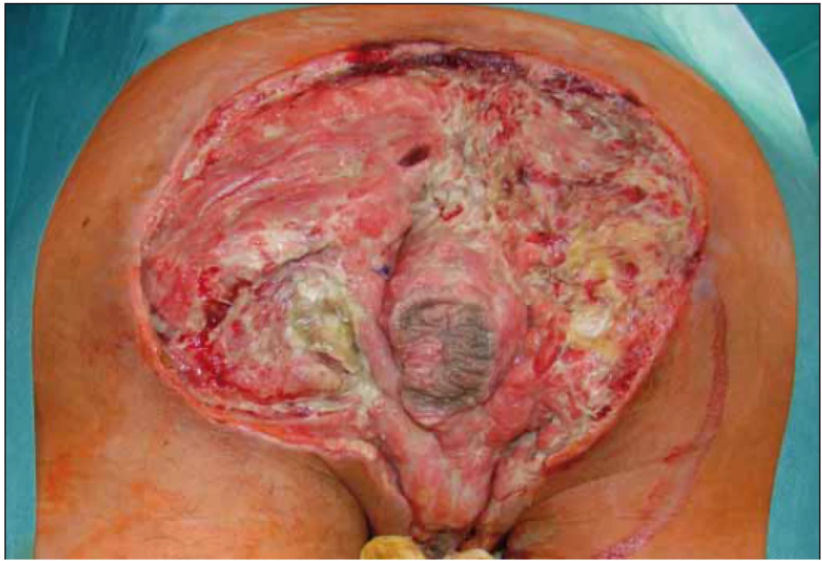 Stav před aplikací podtlakové terapie.<br>
Fig. 3. Status before negative pressure wound therapy aplication.