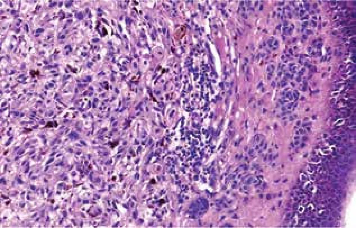 Histologický nález – vlevo melanom, vpravo pod epidermis
proužek névových buněk
V epidermis je melanocytární hyperplazie (HE, zvětšení 400x).