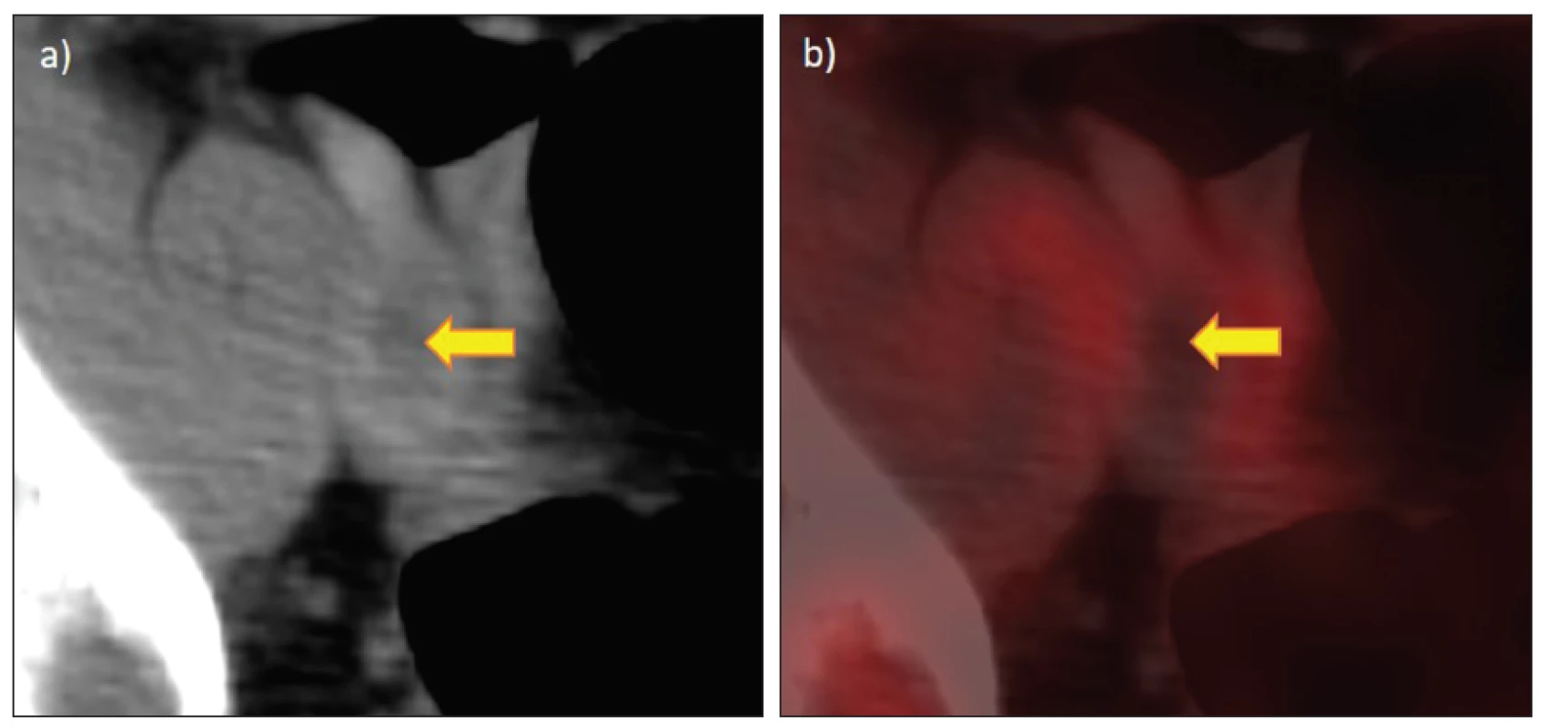 FDG PET/CT u ileofemorální flebotrombózy bez akumulace, náhodný nález u 31letého pacienta s akutní lymfoblastickou leukémií
ve vazbě na předchozí nitrožilní katetr: a) CT vyšetření s defektem kontrastní náplně způsobeným trombem ve v. iliaca communis
sin., b) fúze PET/CT, oblast trombu bez hyperakumulace.