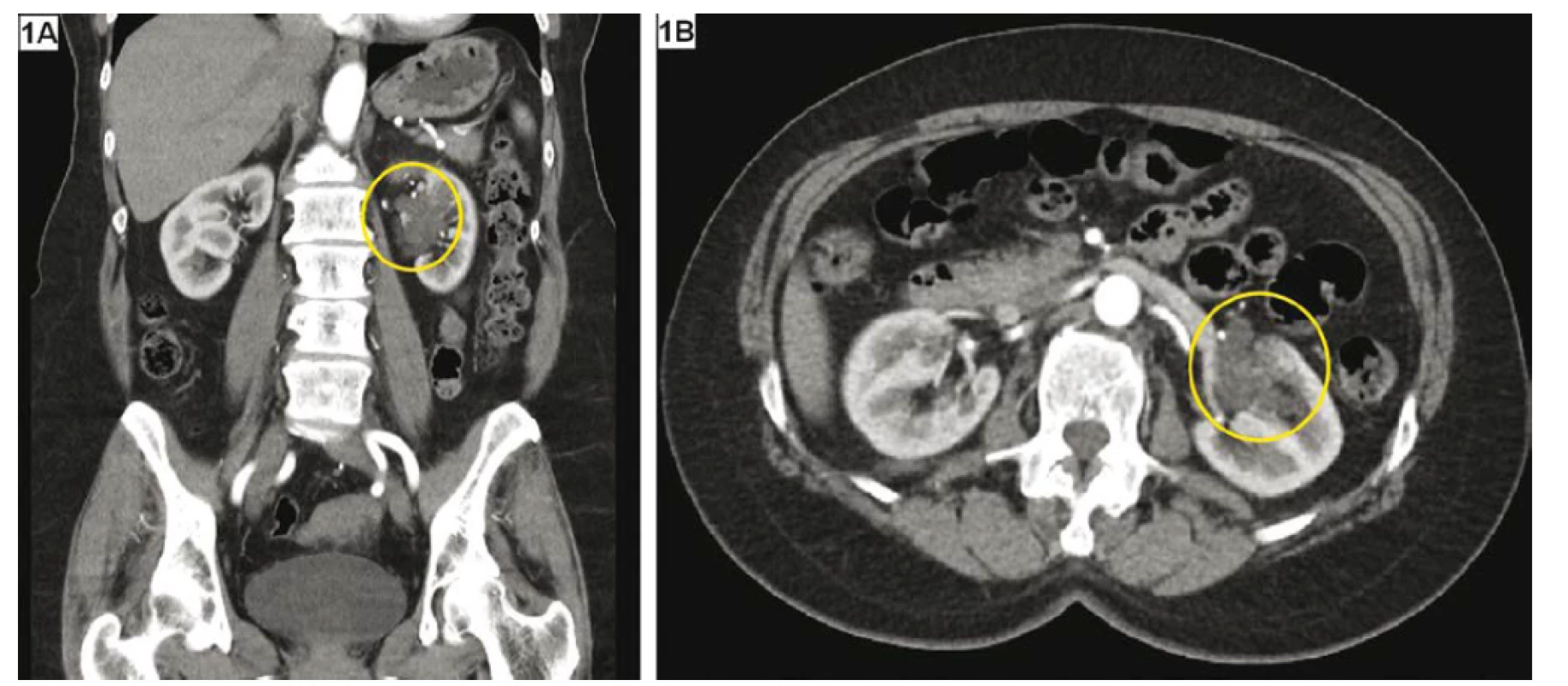 CT zobrazení cystické léze – Bosniak IIF–III; komplex septovaných cyst v levé ledvině; A – koronární řez,
B – axiální řez<br>
Fig. 1. CT imaging of cystic renal lesion – Bosniak IIF–III; multicystic cavities in the left kidney; A – coronal section,
B – axial section