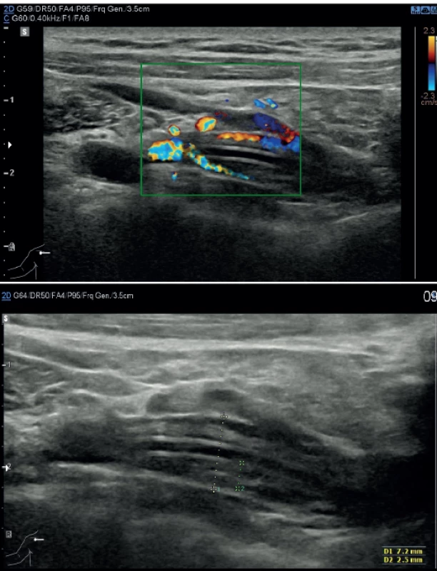 Parciální trombóza vena subclavia v oblasti centrálního
konce katétru; nahoře dopplerovské vyšetření,
dole USG obraz<br>
Fig. 2. Partial thrombosis of subclavian vein where the
central end of the catheter is found: Doppler mode (above);
USG (below)