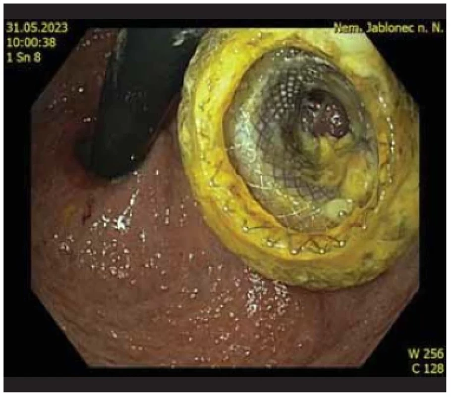 LAMS před extrakcí, retrovize v bulbu duodena. <br> 
Fig. 8. LAMS before extraction, retrovision in the bulb of the
duodenum.