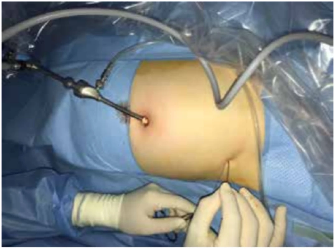 Kožní vpich v třísle nad anulus inguinalis profundus<br>
Fig. 5: Cutaneous puncture above anulus inguinalis profundus