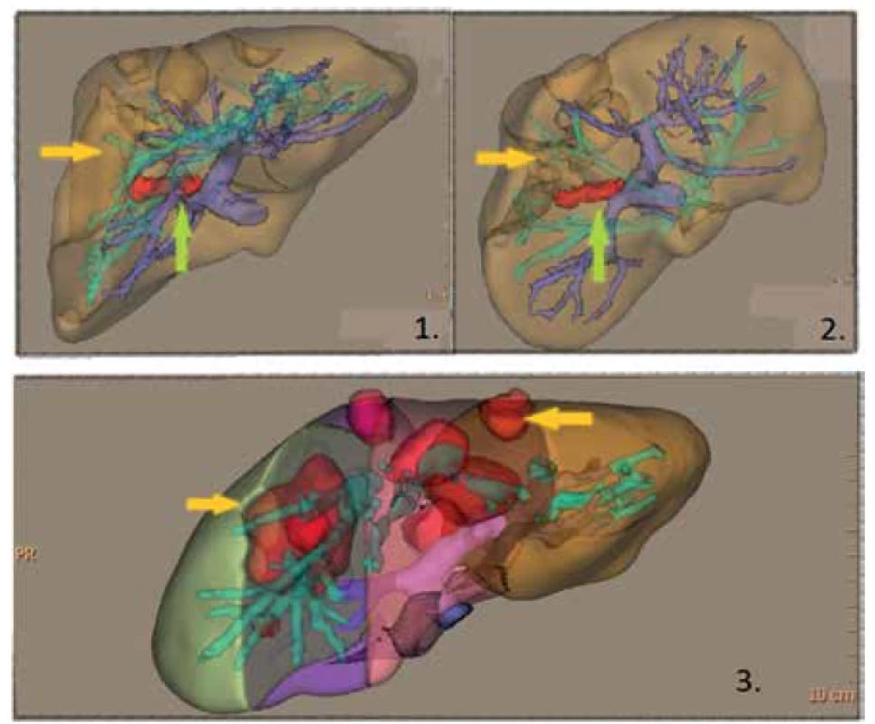 1,2 – 3D rekonstrukce jater s „červenou“ obliterovanou portální větví (zelená šipka)
pro segment V a VIII; změna sycení parenchymu (žlutá šipka); 3 – 3D volumetrie, červená
ložiska označují nefunkční parenchym (žluté šipky)<br>
Fig. 2. 1,2 – 3D reconstruction of the liver with „red“ occluded portal branch (green arrow) for
segments V and VIII; parenchymal hypoperfusion (yellow arrow); 3 – 3D volumetry, red lesions
simulating nonfunctional liver parenchyma (yellow arrows)
