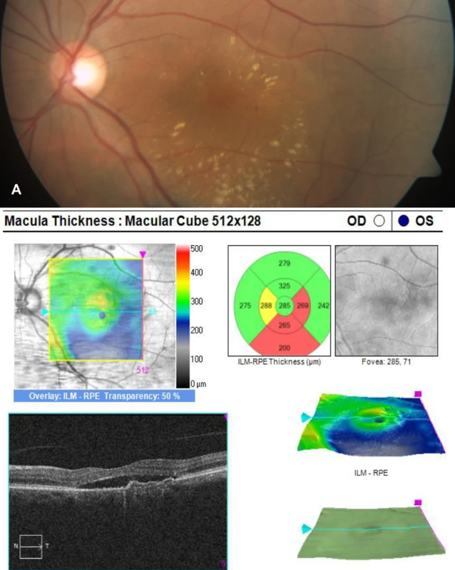 Pachychoroid neovasculopathy. A – ablation of the neuroretina, hard exudates and hemorrhage due to occult occult CNV in PNV. B – OCT finding, serous ablation of the neuroretina, hyper-reflective CNV and ablation of RPE.