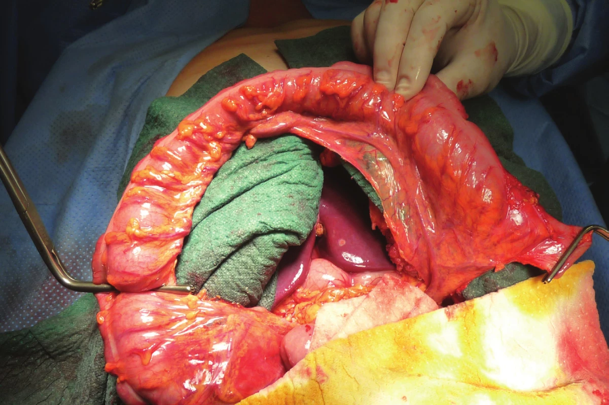 Ligatura
větví a. colica media
s přerušením aborální
části kolon<br>
Fig. 3: Ligature of
branches of the middle
colic artery with
discission of the aboral
part of the colon