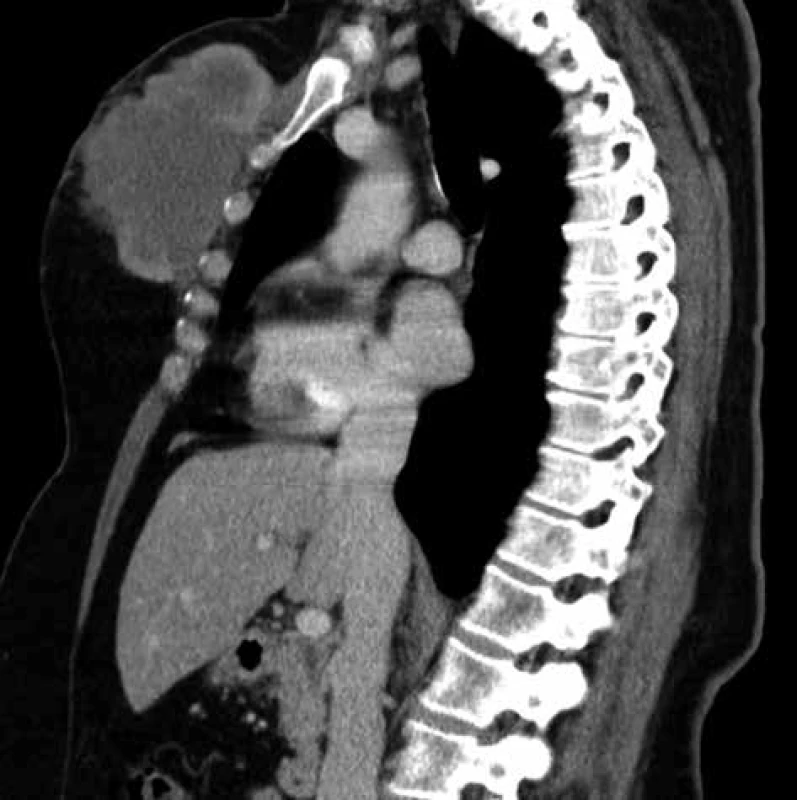 Ambulantní CT scan tumoru pektorální oblasti
Źlutá šipka − sebaceózní karcinom <br>
Fig. 1: Outpatient CT scan of tumor in pectoral area
Yellow arrow − sebaceous carcinoma