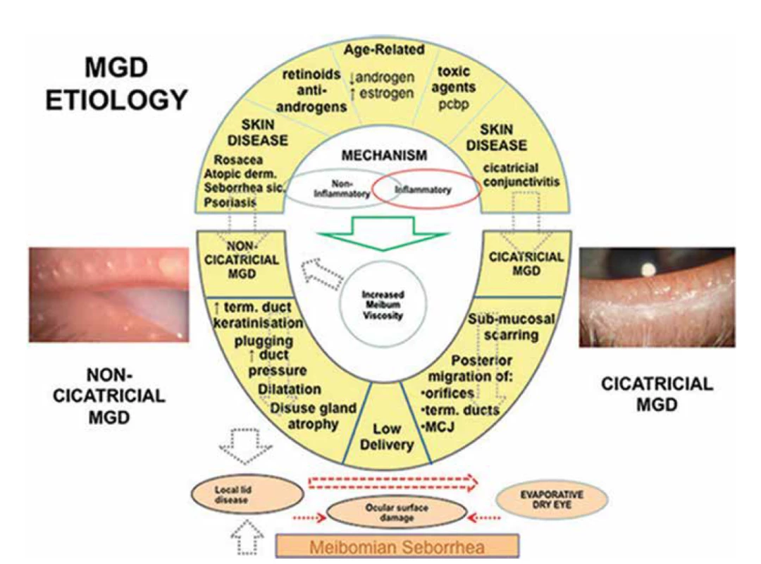 Patofyziologie MGD – TFOS DEWS II REPORT [2]