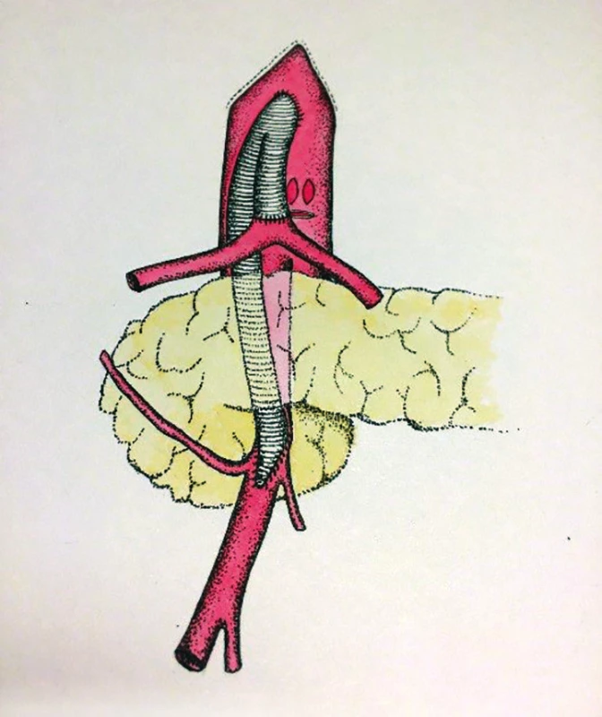 Antegrádní (supraceliakální) bypass
na TC a AMS (schéma MUDr. Táňa
Baráková)<br>
Fig. 6: Antegrade (supraceliac) bypass
on the celiac trunk and superior mesenteric
artery