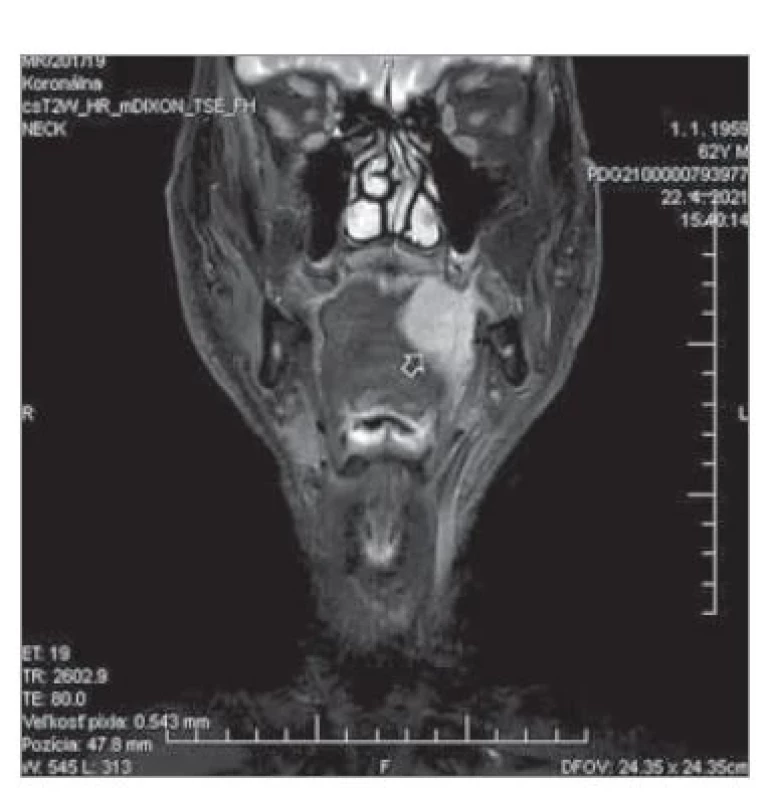 MR pacienta s karcinómom
hrany a tela jazyka vľavo (šípka) indikovaného
na CTS.<br>
Fig. 2. MRI of the patient with carcinoma
of the tongue margin and body
(arrow) indicated for CTS.