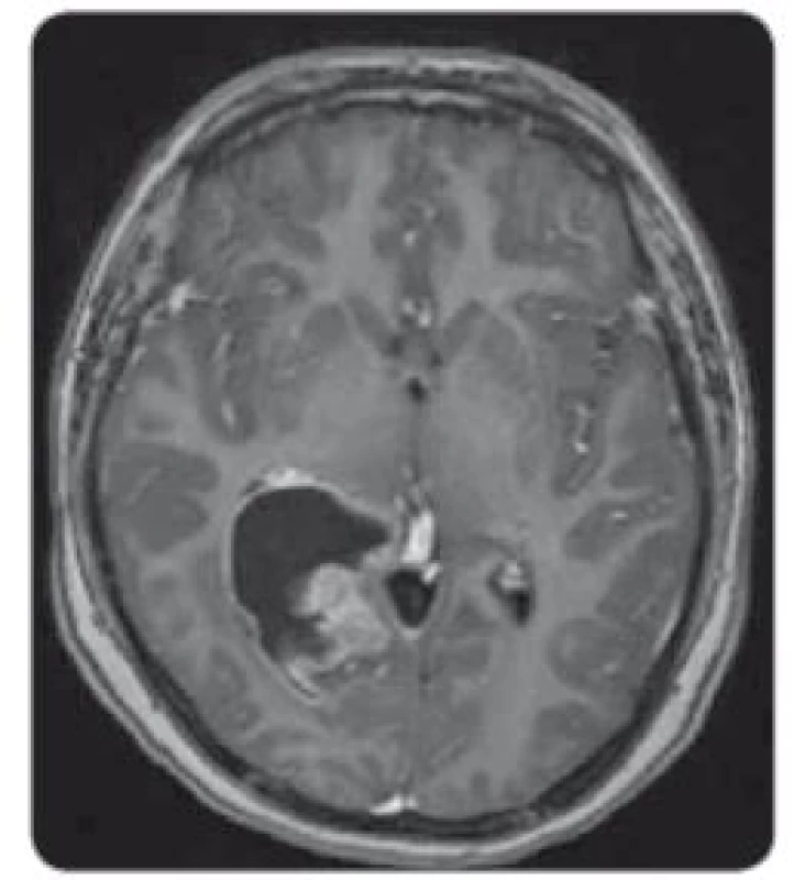 MRI, T1 vážené obrazy s kontrastem
– solidně-cystický tumor supratentoriálně
vpravo v trigonu pravé postranní
komory, sytící se solidní složka.