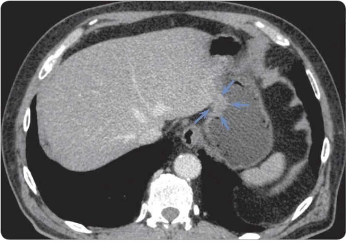 An axial contrast-enhanced CT image at the level of the abdomen shows tumour
of the gastric fundus (blue arrows).