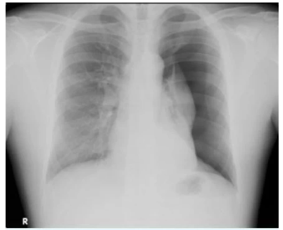 Kompletní primární spontánní pneumotorax bez
přesunu mediastinálních struktur