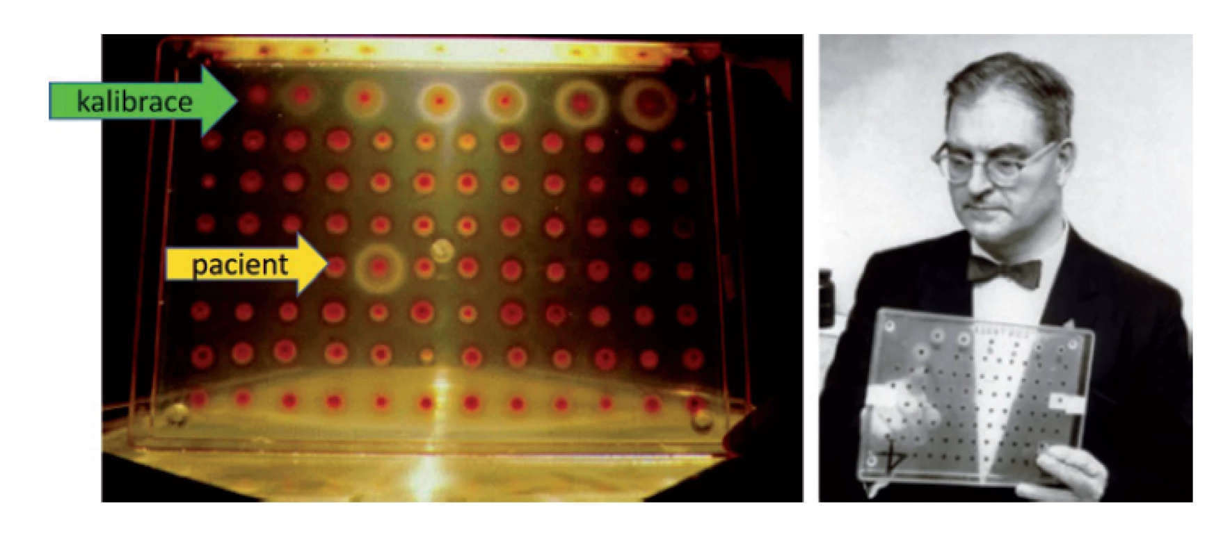Robert Guthrie (1916–1995) a laboratorní
novorozenecký screening fenylketonurie
(http://pkuworld.org/home/docs/
history/guthrie200.jpg). Metoda využívá
na fenylalaninu závislý růst kultury bakterií
Bacillus subtillis, jež se lépe a rychleji dělí
v přítomnosti vyšší hladiny fenylalaninu
difundující do kultivačního média z papírku
nasátého kapilární krví dítěte s fenylketonurií.