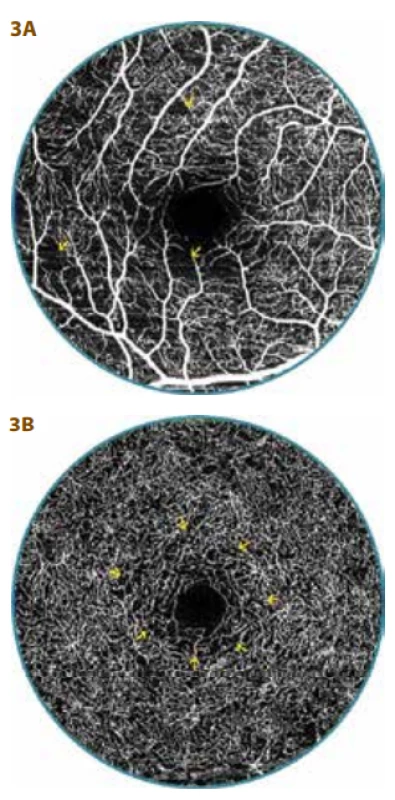 OCT-A examination of 20 year old
diabetic patients (16 year duration of diabetes) with diabetic preretinopathy (DpR)<br>
A. Evident multiple smaller zones of
non-perfusion in superficial vascular
complex (arrows), indication of overlap
of vascular capillary nodes into foveal
avascular zone (FAZ)<br>
B. Capillary network is regular in deep
vascular complex, but slightly thinner
around FAZ (arrows), FAZ surface is wider – 0.37 mm2