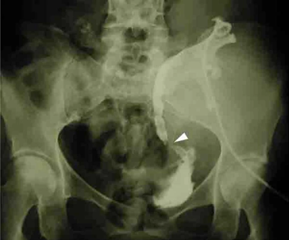 Antegrádna pyeloureterografia. Urinózna fistula podmienená nekrózou močovodu<br>
Fig. 7. Antegrade pyeloureterography. Arrow points to a urinary fistula due to uretal necrosis
