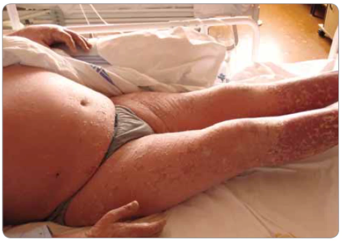 Rozsáhlá kožní reakce štěpu proti hostiteli u pacienta po alogenní transplantaci
krvetvorných buněk (foto S. Vokurka, FN Plzeň).