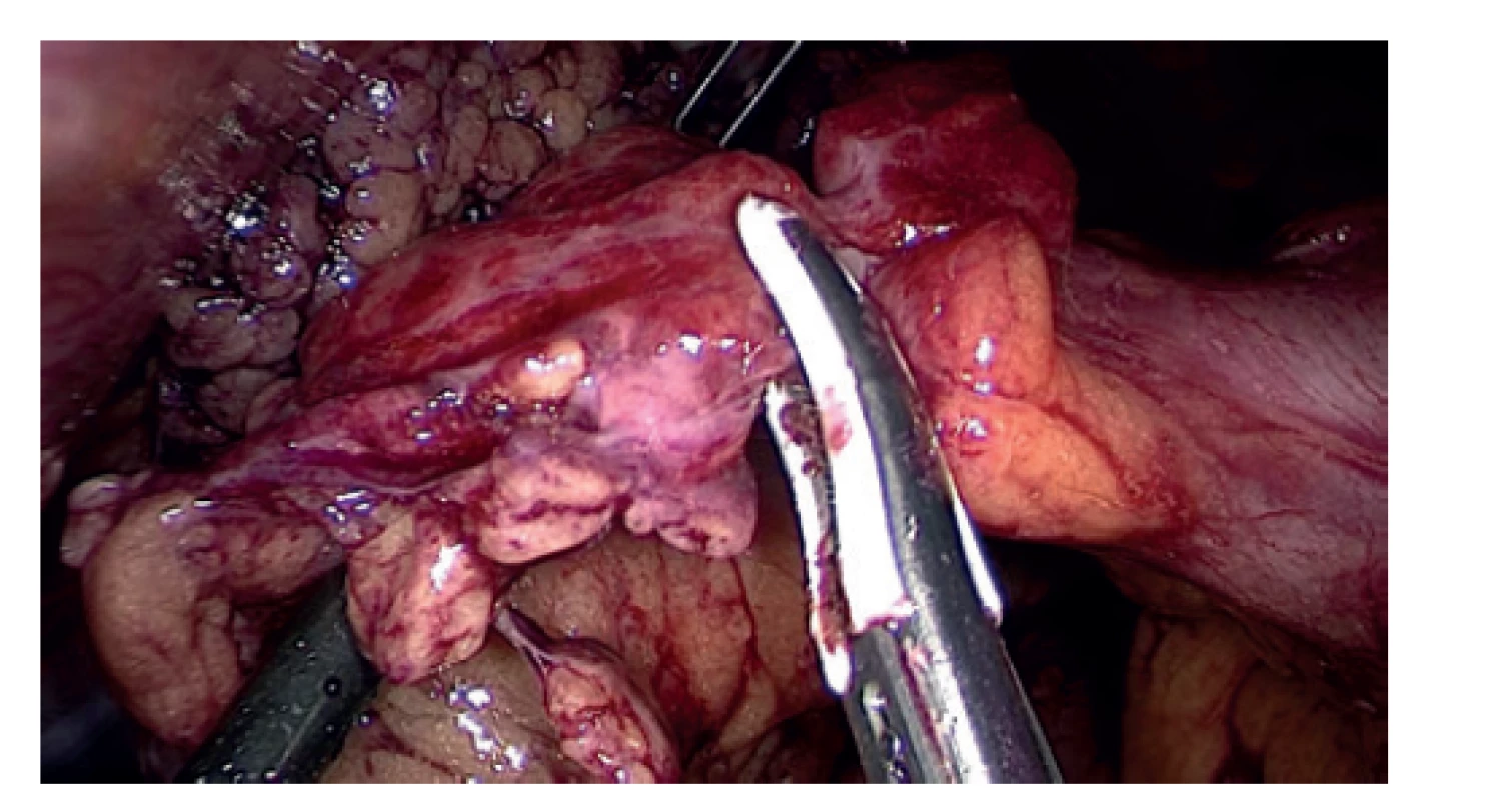 Resekce torkvované části omenta<br>
Fig. 4: Resection of the torqued part of omentum