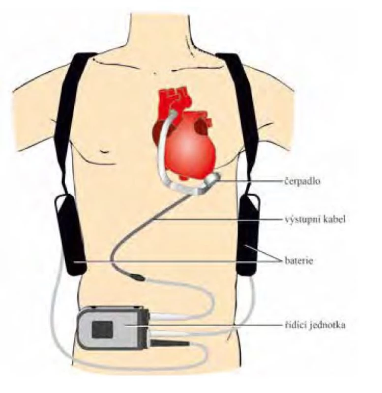 LVAD a jeho zapojení