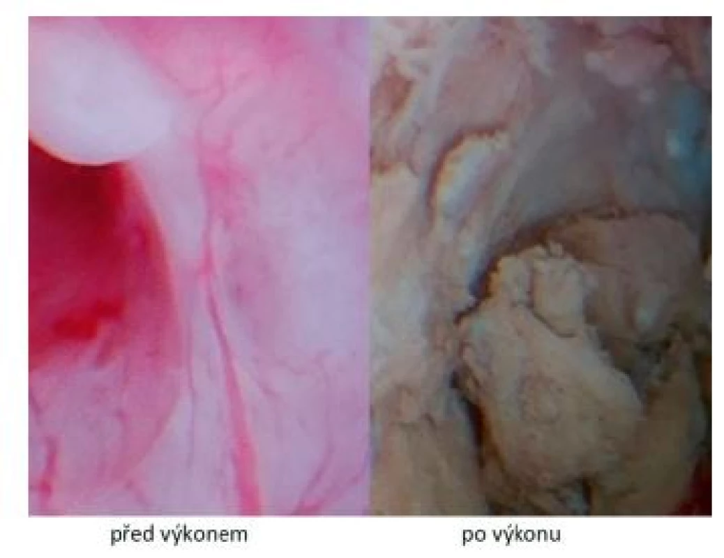 Hysteroskopické vizuální srovnání endometria těsně před
výkonem a po jeho ošetření radiofrekvenční ablací
