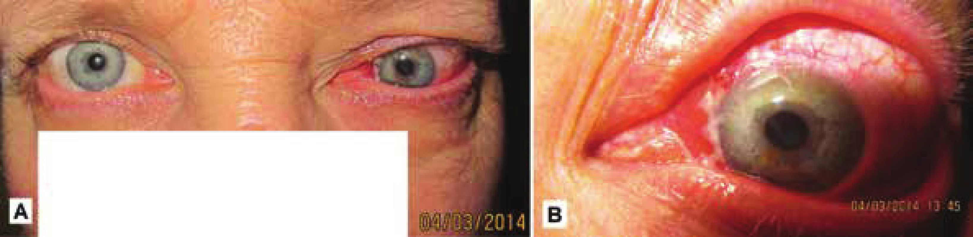 Clinical
picture of the
same patient in
March 2014 –
progression with
tendency of infiltration
into orbit