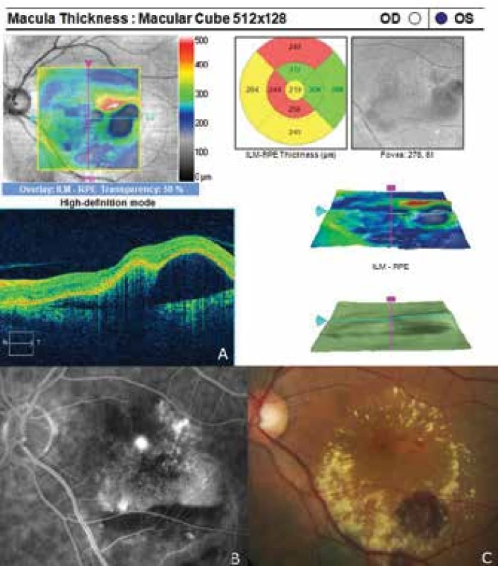 Finding of polypoid choroidal vasculopathy