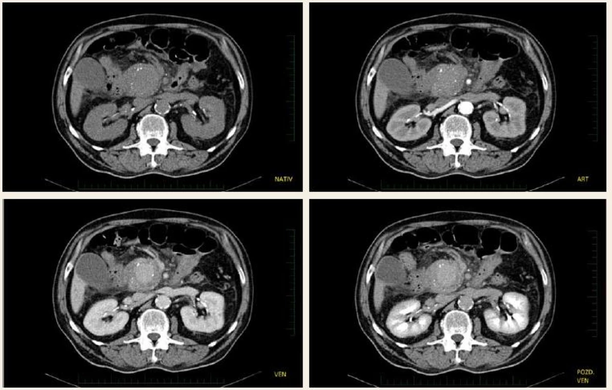 CT vyšetření – pankreatická pseudocysta s maximálním sycením ve venózní fázi.
Fig. 1. CT scan – pancreatic pseudocyst with maximum enhancement in the venous phase.