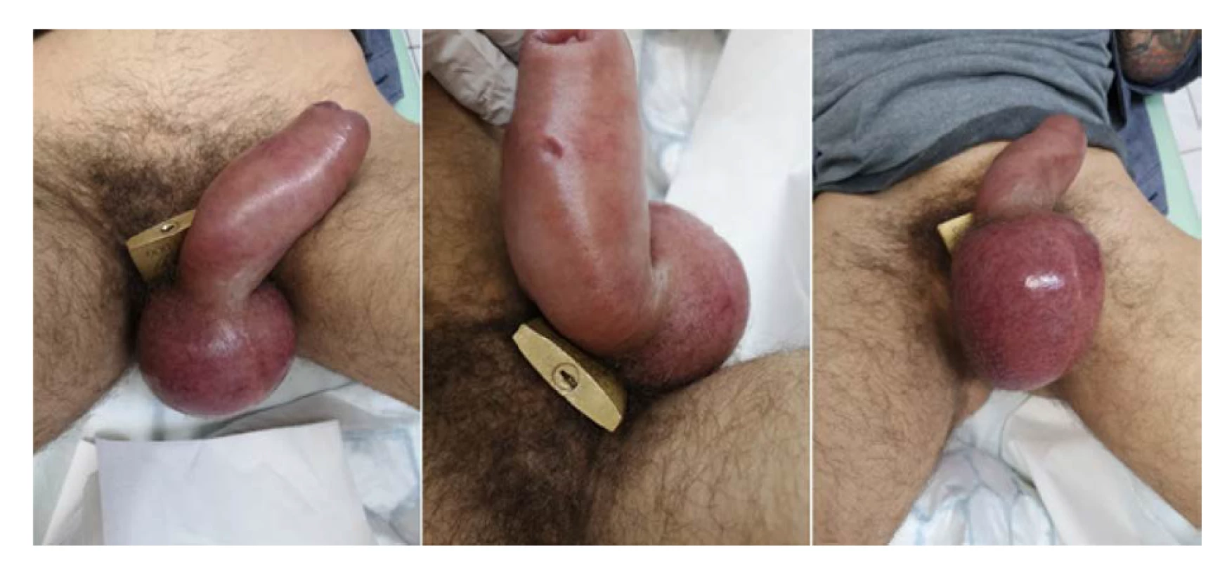 Visací zámek uzamčený kolem penisu a skrota<br>
Fig. 1. A padlock locked around penis and scrotum