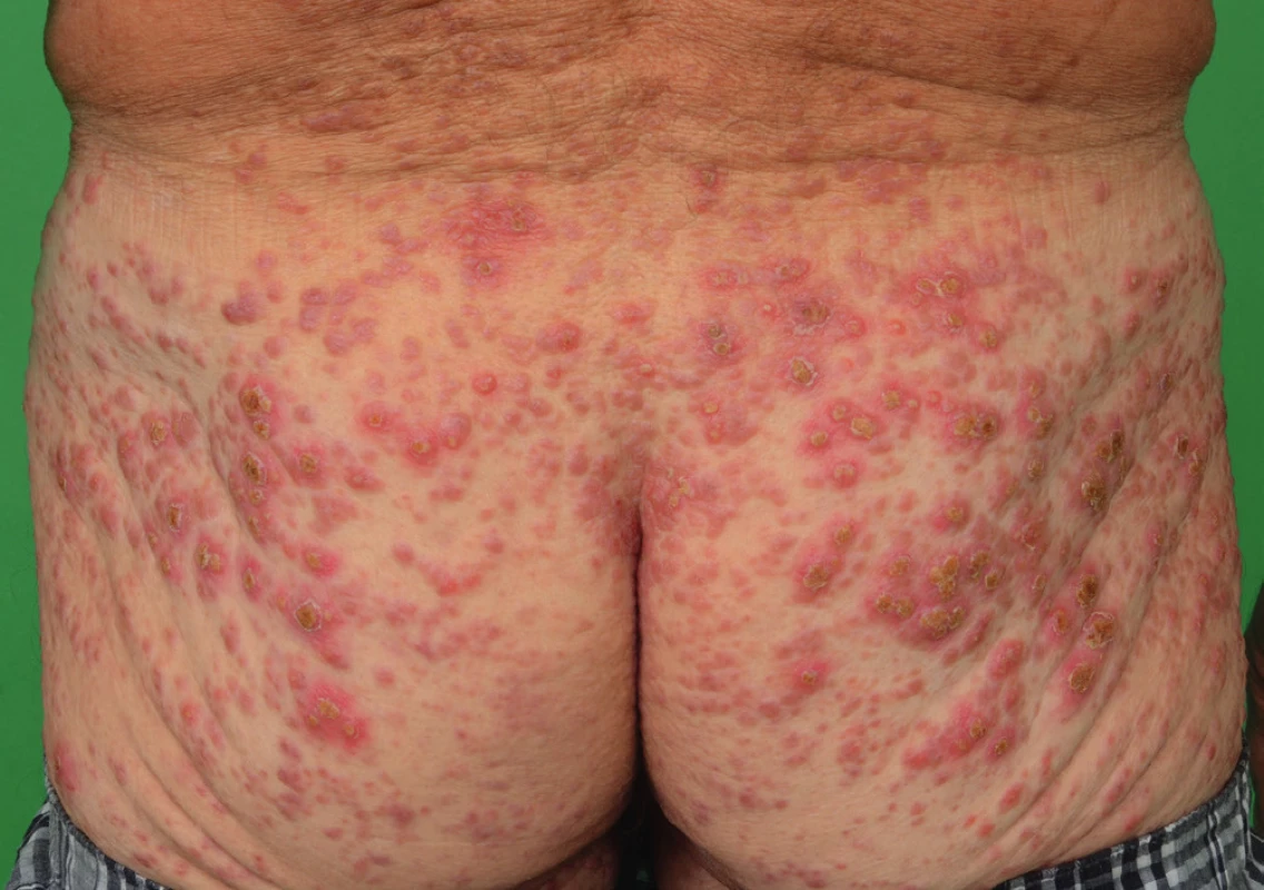 Vývoj kožních projevů indeterminate-cell histiocytosis
o 4 měsíce později v dubnu 2016