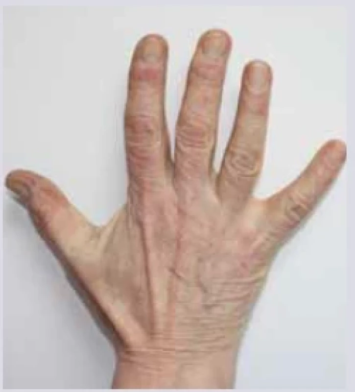 Gottronovy papuly. <br> 
Fig. 16. Gottron papules.