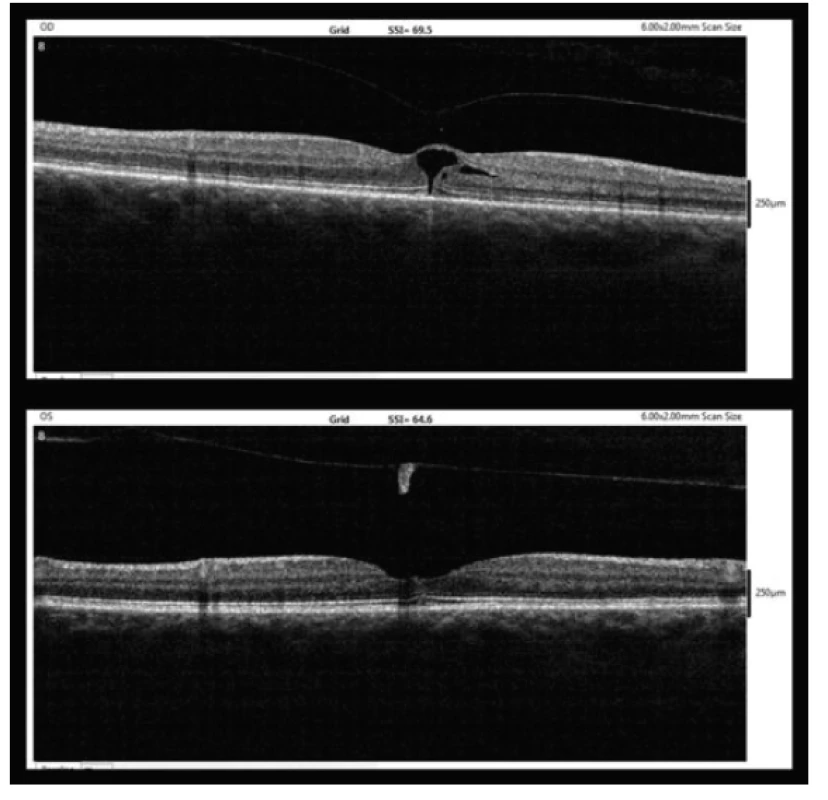 OCT findings five weeks after MH diagnosis (10/2017, upper
– right eye, lower – left eye)