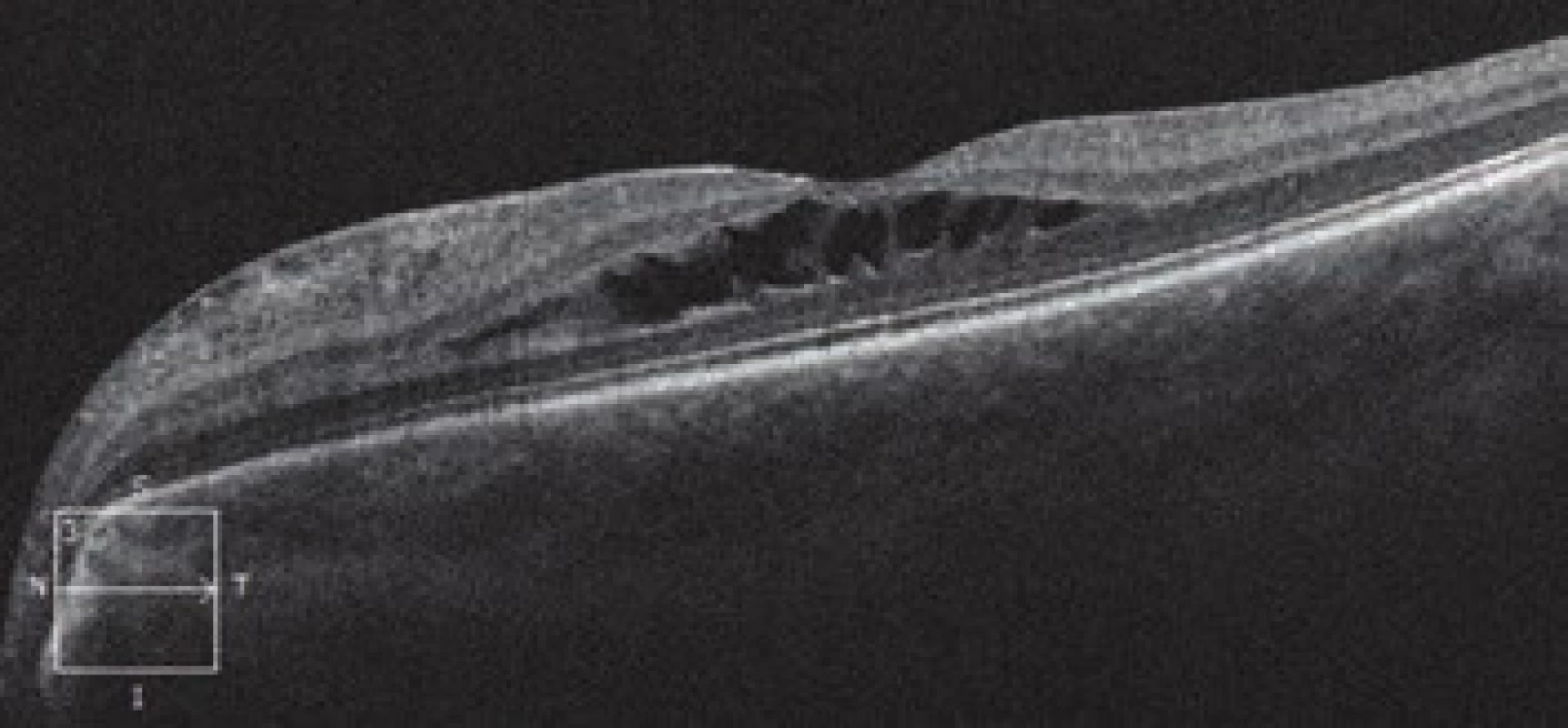 HD-OCT: Linear horizontal transfoveolar scan of left
eye with image of schisis-like maculopathy, with separation
in the region of central retinal layers