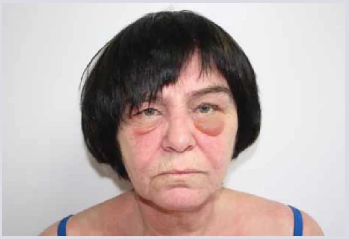 Heliotropní erytém. <br> 
Fig. 15. Heliotrope rash.
