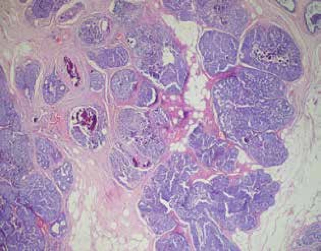 Histologie DCIS <br>
Fig. 1: DCIS histology