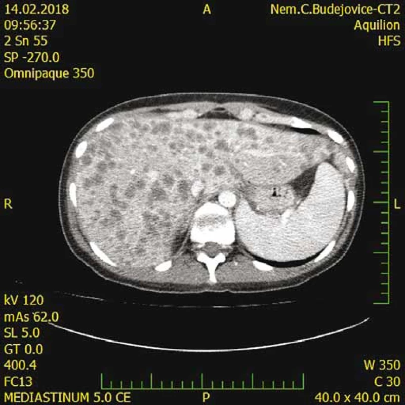 CT s nálezom difúzneho metastatického procesu
pečene.<br>
Fig. 4. CT scan shows diffuse metastatic process in the liver.
