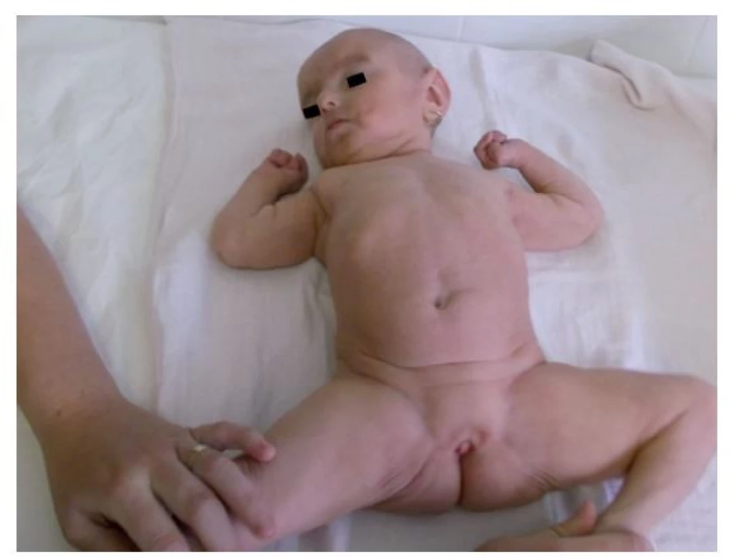 Atypický genitál s výrazne hypoplastickými labia majora
vo veku 17 mesiacov.