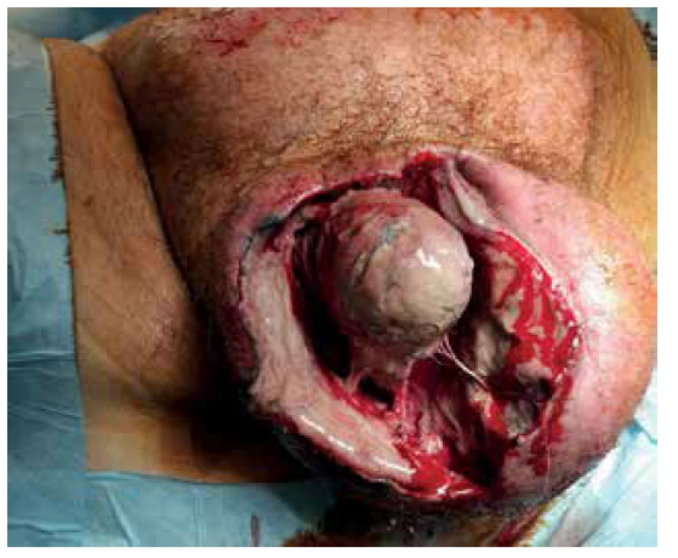 Peritestikulární nekróza s nekrózou pravého varlete<br>
Fig. 3. Peritesticular and right testicular necrosis