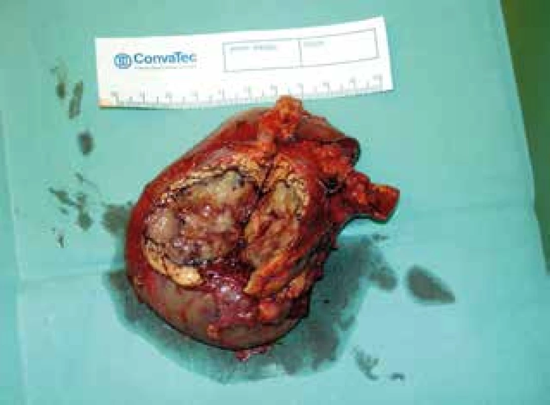 Resekát hlavy pankreatu a duodena se solitární
meta světlobuněčného karcinomu<br>
Fig. 4: Resected section of pancreatic head and duodenum
with a solitary metastasis of clear cell renal carcinoma