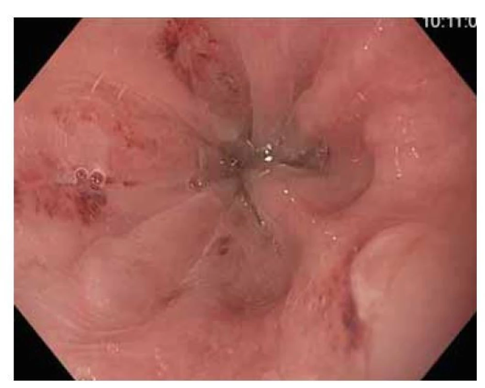 Pohled na EGJ prográdně po Stretta proceduře.<br>
Zdroj: Archiv Oddělení gastrointestinální endoskopie, ÚVN –
Vojenská fakultní nemocnice, Praha.<br>
Fig. 3. View of the EGJ progradely after the Stretta
procedure.<br>
Source: Department of Gastrointestinal Endoscopy archive,
Military University Hospital, Prague, Czech Republic.