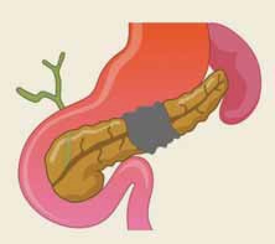 Anatomická situace při odpojeném pankreatickém vývodu vzniklém po akutní nekrotizující pankreatitidě – ilustrace.<br>
Fig. 2. The anatomical situation of the
dis con nected pancreatic duct following
acute necrotizing pancreatitis – an
illustration.