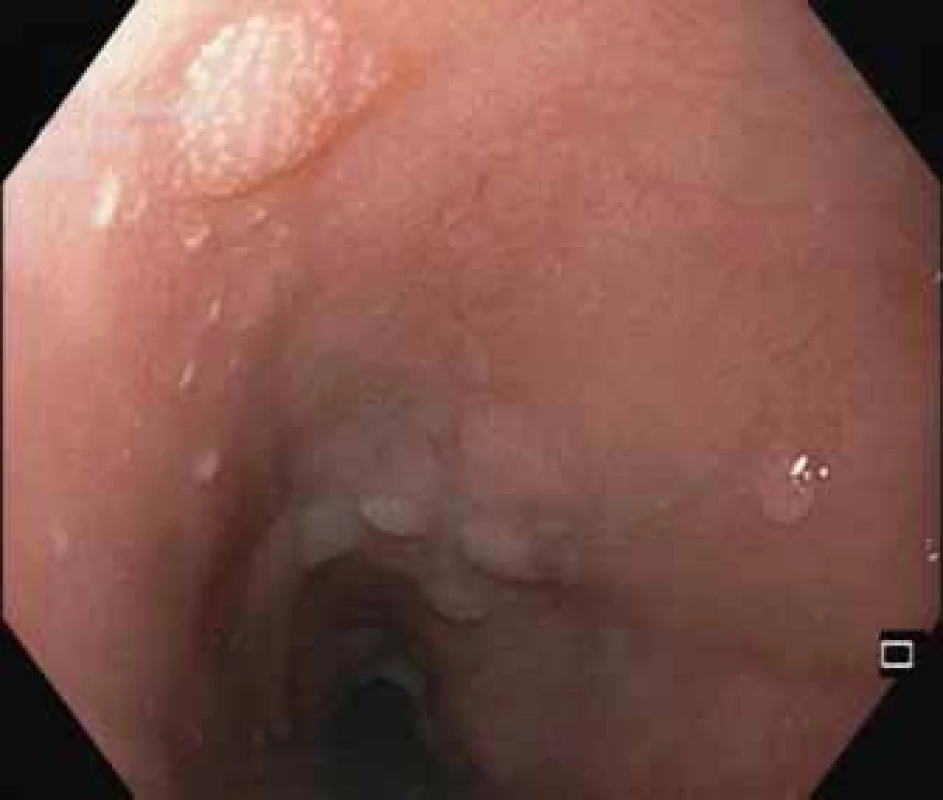 Endoskopický obraz,
signifikantní regrese ezofagitidy
za 5 dnů po vysazení dabigatranu.<br>
Fig. 3. Endoscopic image, significant
regression of esophagitis five days
after discontinuation of dabigatran.