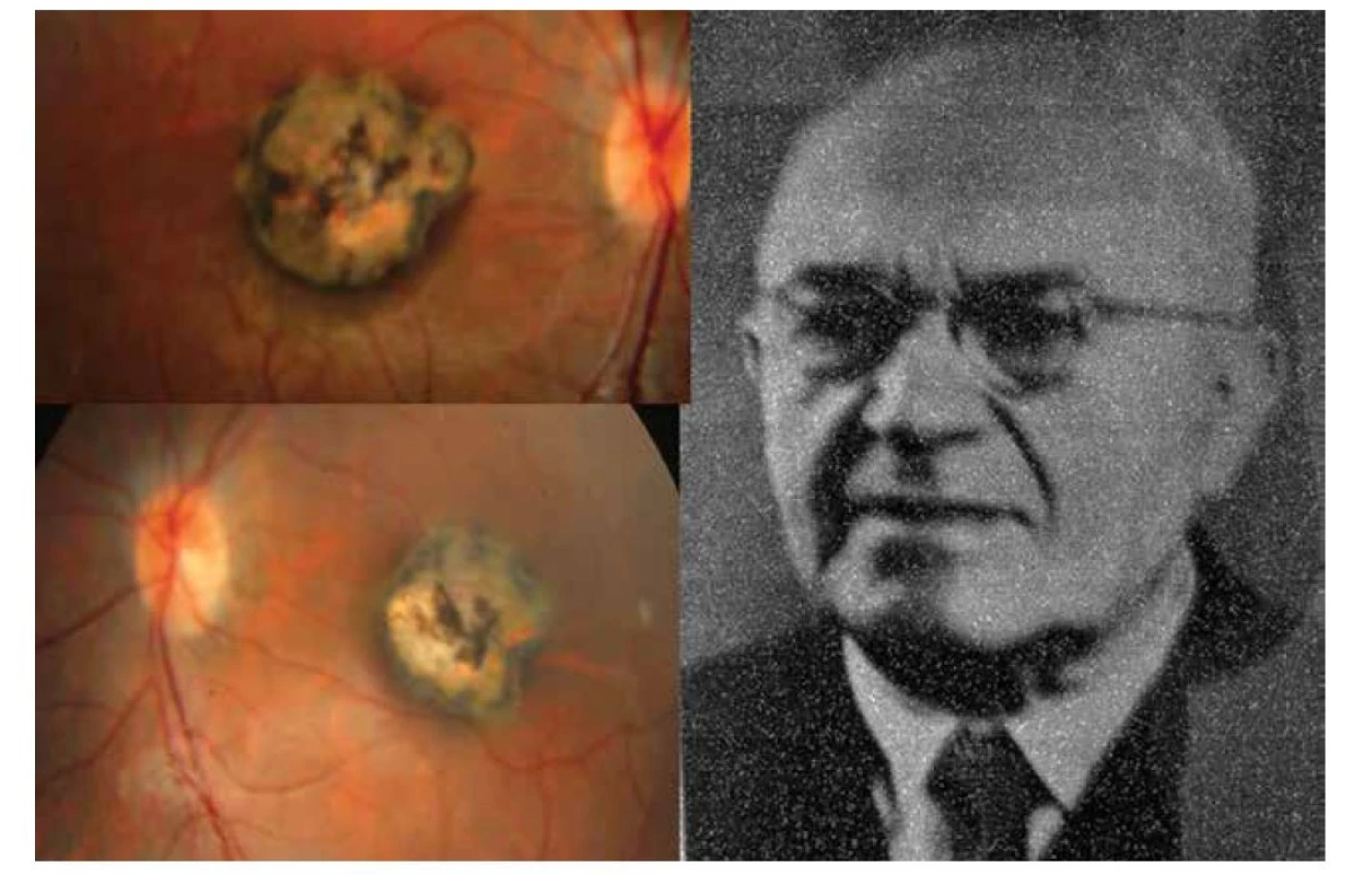Vrozená forma oční toxoplazmózy v podobě oboustranné makulární jizvy – vpravo. Prof. MUDr. Josef
Janků (1886–1963) – vlevo