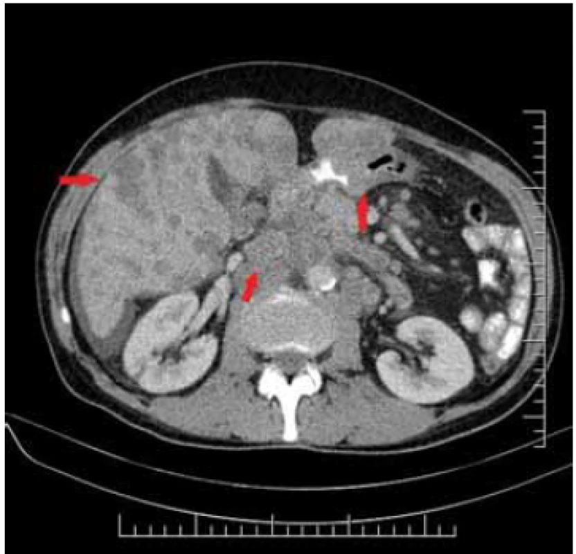 Liver metastases on the right,
centrally-pathologic lymphadenopathy,
on the left tumour of pylorus –
asymetric thickening of the wall.<br>
Obr. 2. Vpravo metastázy heparu, centrálne-
patologická lymfadenopatia,
vľavo tumor pyloru – asymetrické
zhrubnutie steny.